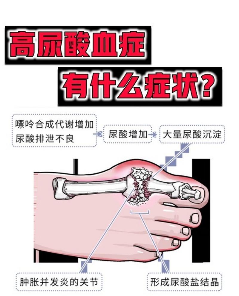 什么是尿酸高什么是痛风:什么是尿酸高,有什么症状